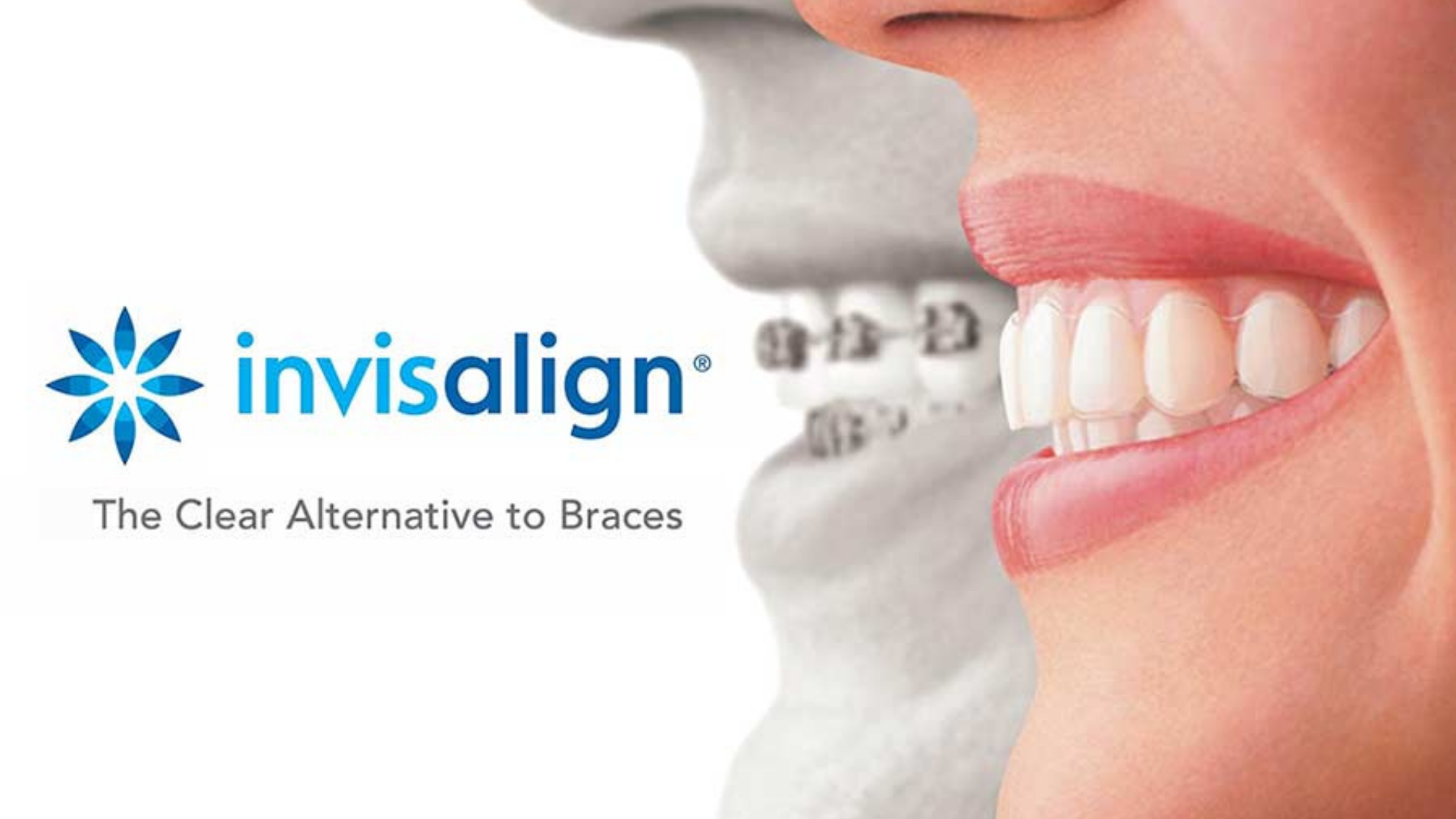 Invisalign Image 1